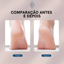 Lixa Elétrica Para os Pés Callus Soft™ - Removedor de Calos e Rachaduras - Mundo Zoom 